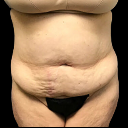 Tummy Tuck Before & After Patient #5084