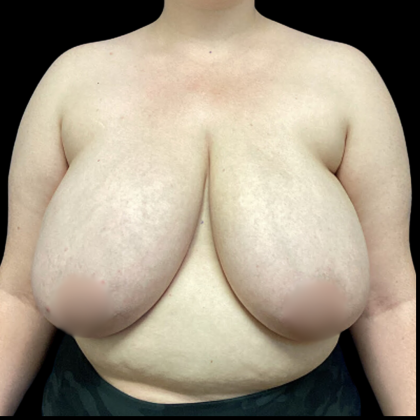 Breast Reduction Before & After Patient #5085