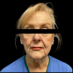 Facelift Before & After Patient #5086
