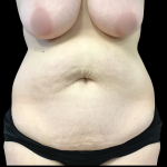 Mommy Makeover Before & After Patient #4907