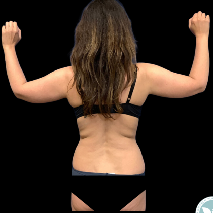 Arm Lift Before & After Patient #4946