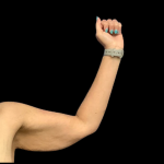 Arm Lift Before & After Patient #4947