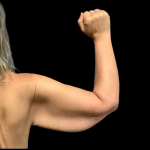 Arm Lift Before & After Patient #4948