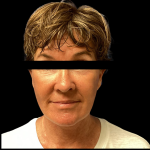 Facelift Before & After Patient #4890