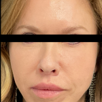 Facelift Before & After Patient #4905