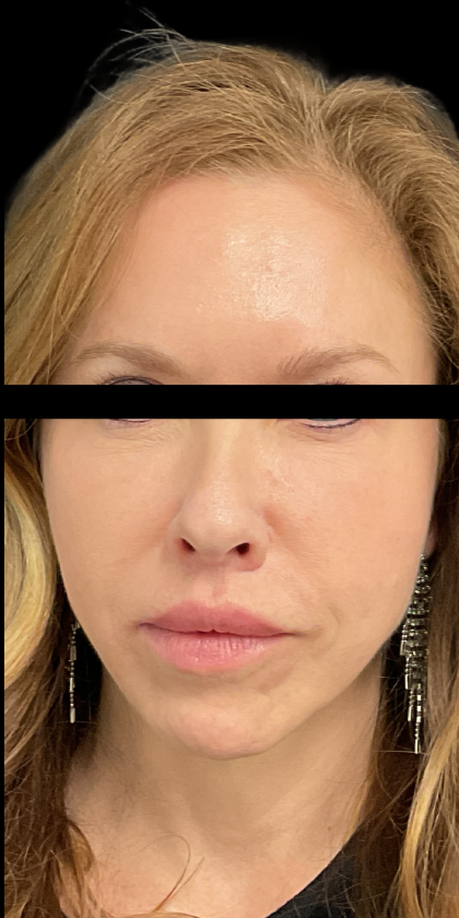 Facelift Before & After Patient #4905
