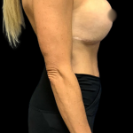 Breast Augmentation Before & After Patient #4949