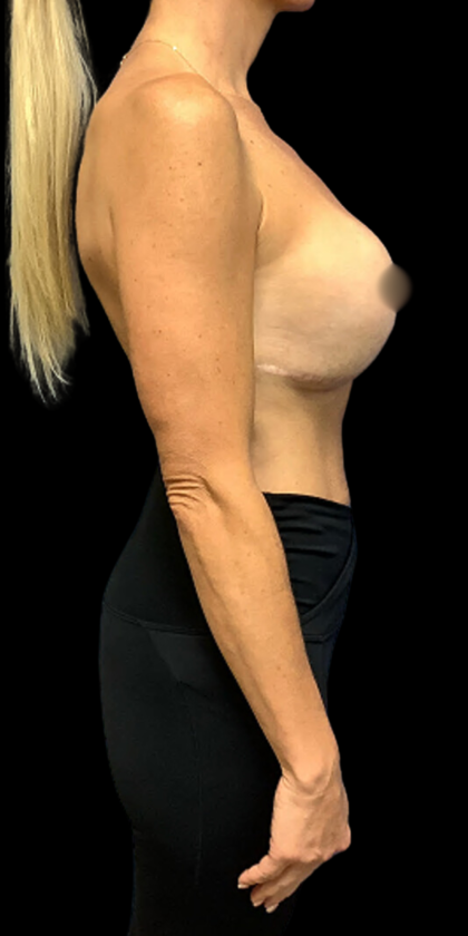 Breast Augmentation Before & After Patient #4949