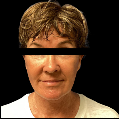 Facelift Before & After Patient #4890