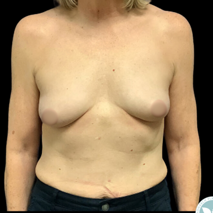 Breast Augmentation Before & After Patient #4950