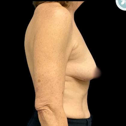 Breast Augmentation Before & After Patient #4950
