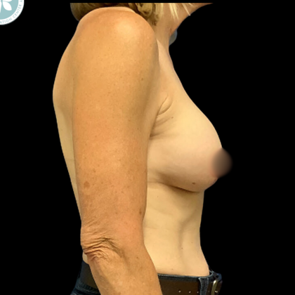 Breast Augmentation Before & After Patient #4950