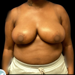 Breast Reduction Before & After Patient #4954