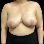 Breast Reduction Before & After Patient #4956