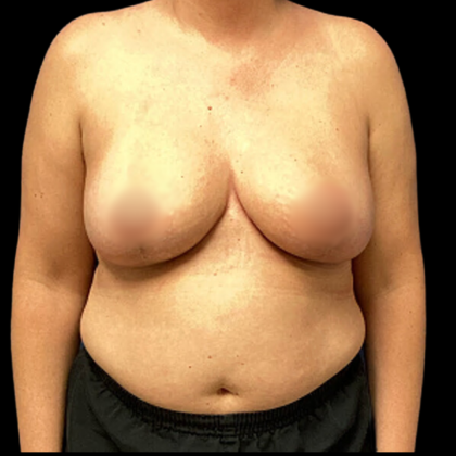 Breast Reduction Before & After Patient #4957
