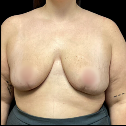 Breast Reduction Before & After Patient #4958