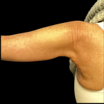 Arm Lift Before & After Patient #4891
