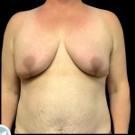 Breast Reduction Before & After Patient #4959