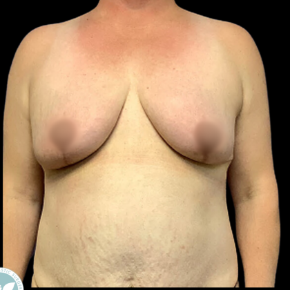 Breast Reduction Before & After Patient #4959