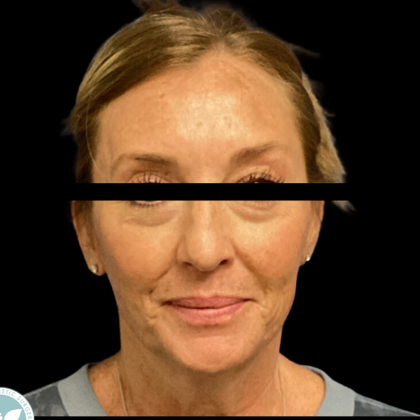 Facelift Before & After Patient #4960