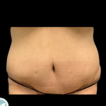 Liposuction Before & After Patient #4962