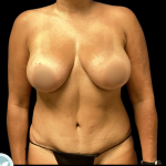 Mommy Makeover Before & After Patient #4964