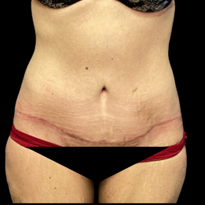 Tummy Tuck Before & After Patient #4965