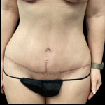 Tummy Tuck Before & After Patient #4967