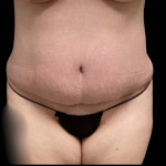 Tummy Tuck Before & After Patient #4968