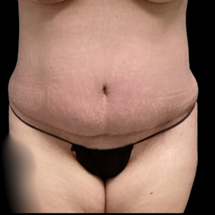 Tummy Tuck Before & After Patient #4968