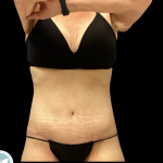 Tummy Tuck Before & After Patient #4971