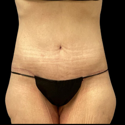 Tummy Tuck Before & After Patient #4972