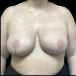 Breast Reconstruction Before & After Patient #4903