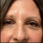 Blepharoplasty Before & After Patient #5079