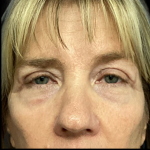 Blepharoplasty Before & After Patient #5080