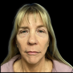 Facelift Before & After Patient #5081