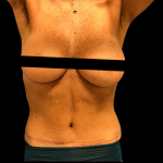 Mommy Makeover Before & After Patient #5082