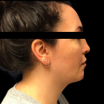 Neck Lift Before & After Patient #5083