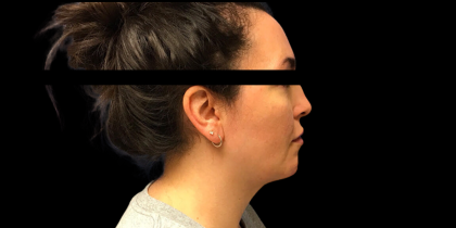 Neck Lift Before & After Patient #5083