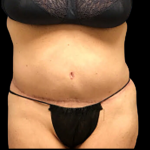 Tummy Tuck Before & After Patient #5084
