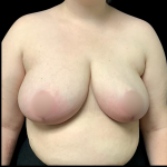 Breast Reduction Before & After Patient #5085
