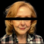 Facelift Before & After Patient #5086