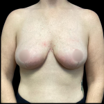 Breast Reduction Before & After Patient #4904
