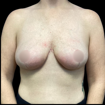 Breast Reduction Before & After Patient #4904