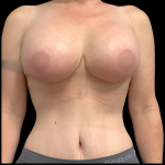 Mommy Makeover Before & After Patient #4907