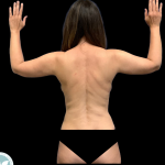 Arm Lift Before & After Patient #4946