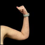 Arm Lift Before & After Patient #4947