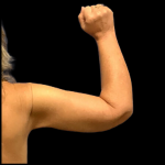 Arm Lift Before & After Patient #4948