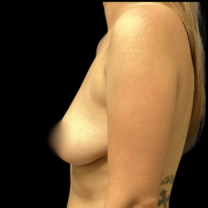 Breast Augmentation Before & After Patient #4900