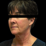 Facelift Before & After Patient #4890